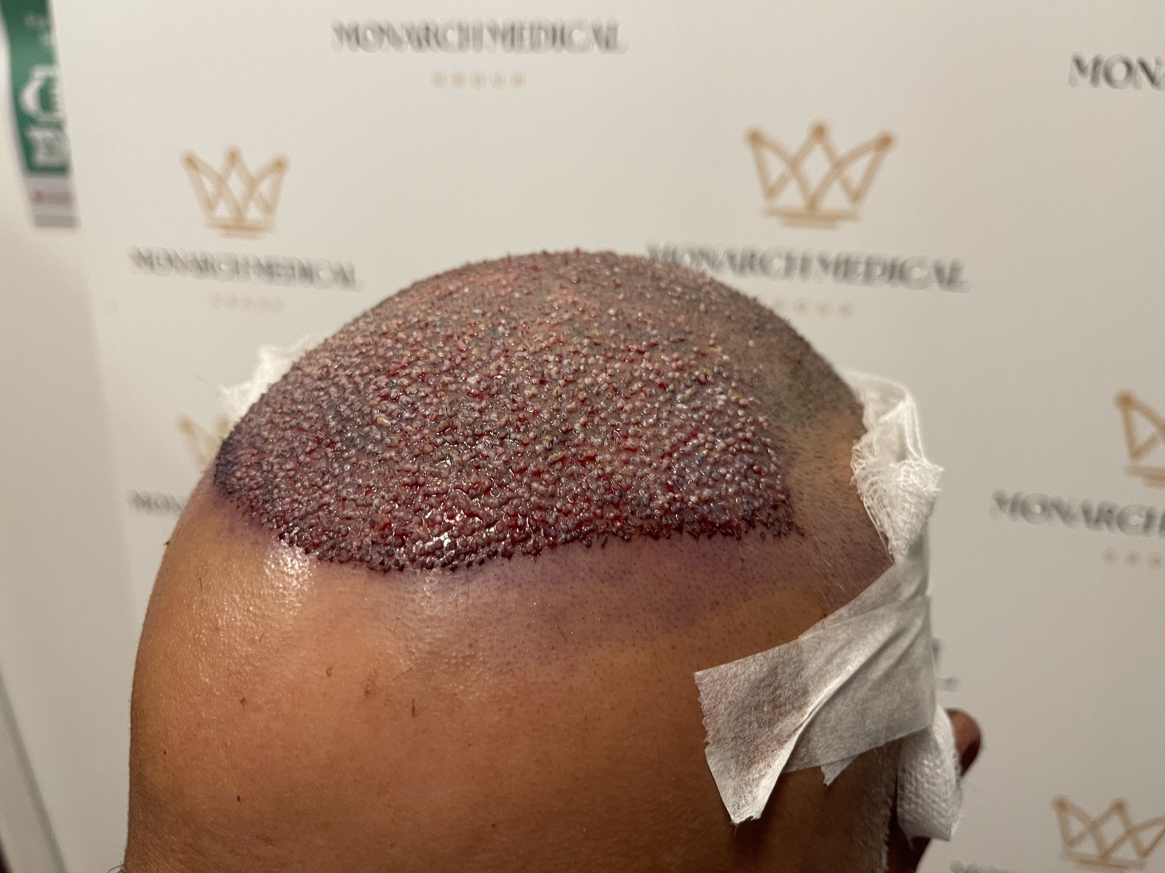 Nishant hair transplant result photo 4